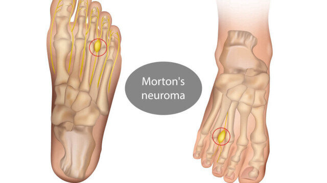 Uzmanından "morton nöroma" hastalığına ilişkin uyarılar