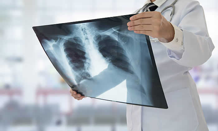 Akciğer Sağlığınızı Göz Ardı Etmeyin: Akciğer Grafisi Ne İşe Yarar?