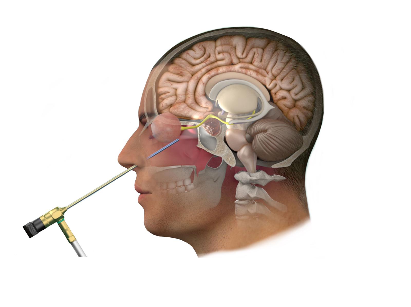Endoskopik hipofiz cerrahisi ile burun deliğinden beyin ameliyatı