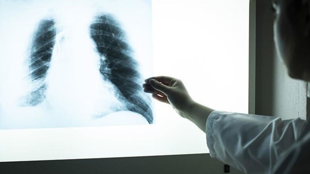 Akciğer kanserine yakalanma riski erkeklerde 3,5 kat fazla