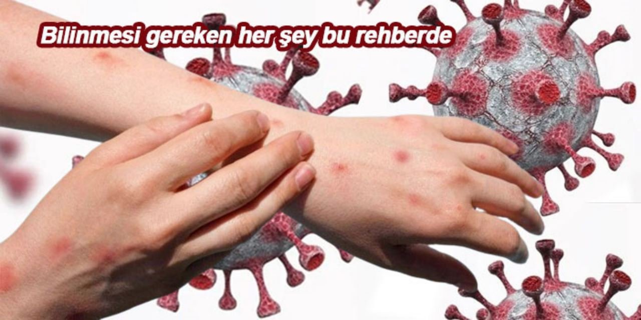 Sağlık Bakanlığı’ndan maymun çiçeği rehberi