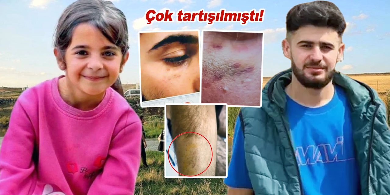 Narin'in ağabeyi Enes'in kolundaki ısırık izinin görüntüleri ortaya çıktı