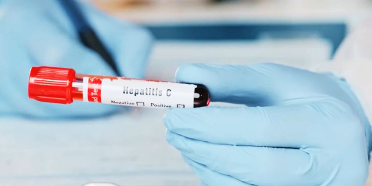 Türkiye'de 3 milyona yakın hepatit hastası var